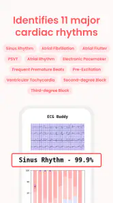 ECG Buddy | ECG Analysis AI screenshot