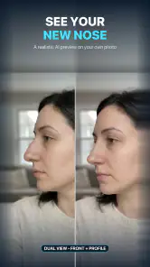 Nose Job - Plastic Surgery AI screenshot